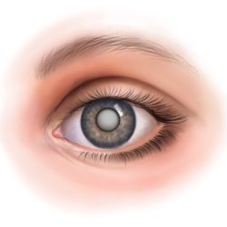 Хрусталик и катаракта глаза