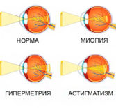 Рефракция глаза и ее аномалии
