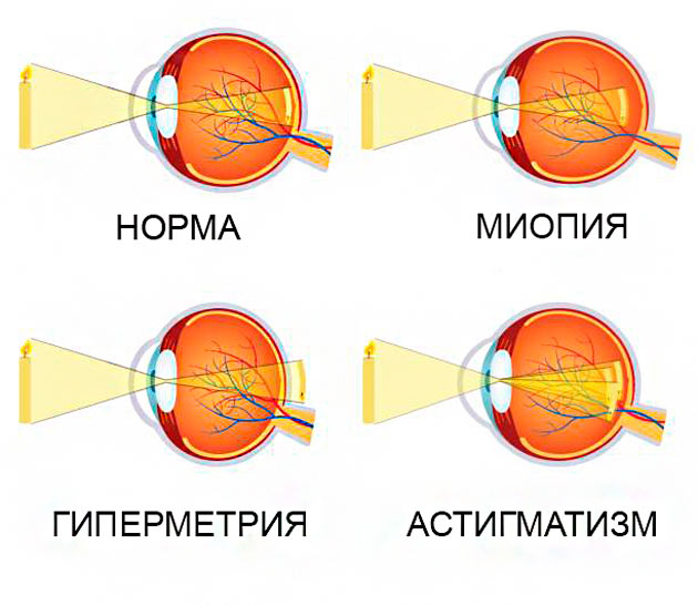 Что такое рефракция глаза?